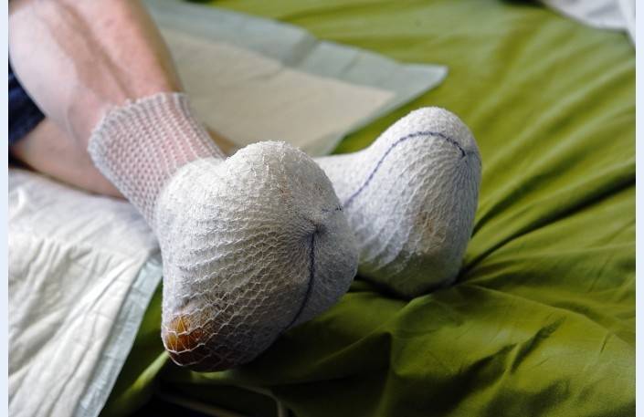 Janvārī ķermeņa atdzišana un apsaldējumi konstatēti jau vairāk nekā 100 cilvēkiem