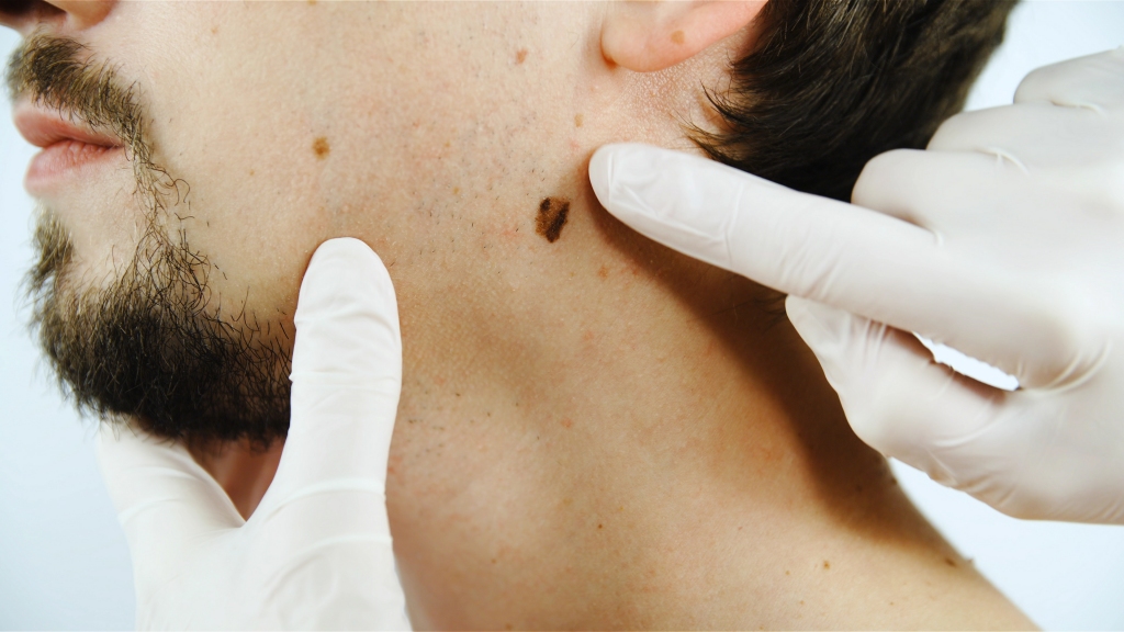Dermatologs: "Ja melanoma tiks atklāta vēlās stadijās, no tās gada laikā nomirs tikpat daudz cilvēku kā no Covid-19"