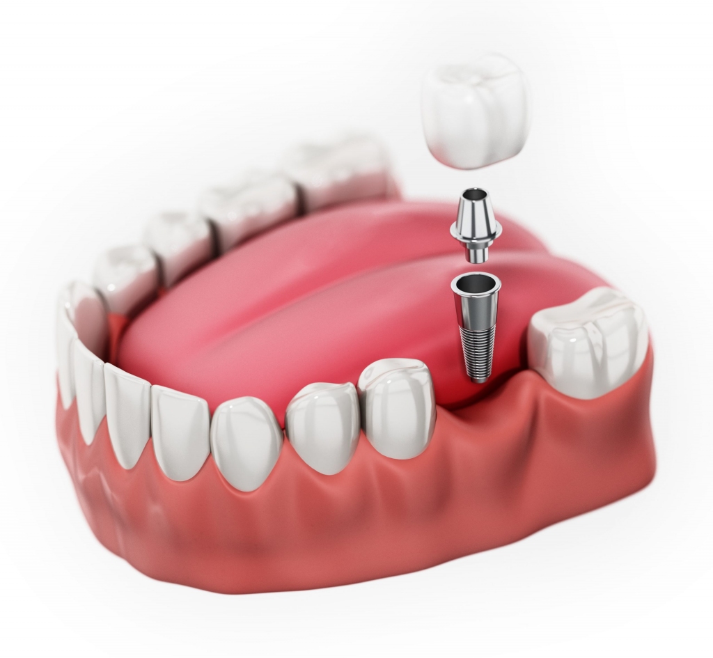 Zoba implanta priekšrocības